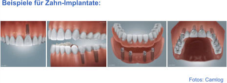 Fotos: Camlog  Beispiele für Zahn-Implantate: