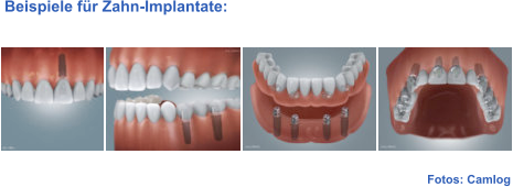 Fotos: Camlog  Beispiele für Zahn-Implantate: