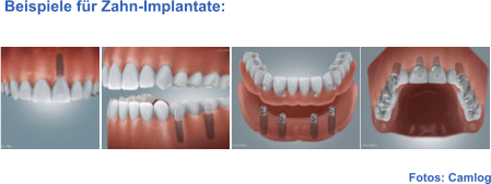 Fotos: Camlog  Beispiele für Zahn-Implantate: